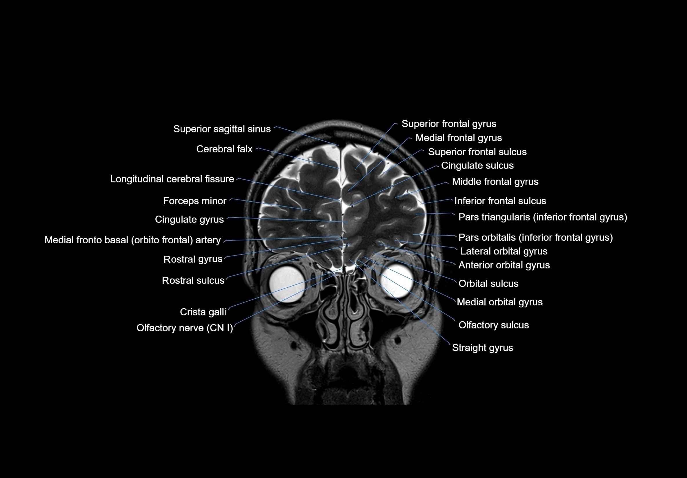 MRI Brain coronal cross sectional labelled anatomy 3T image  -img-00001-00014.webp